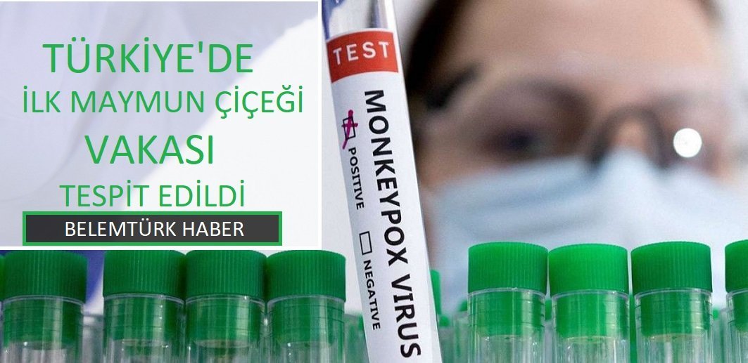 Türkiye’de ilk maymun çiçeği vakası tespit edildi