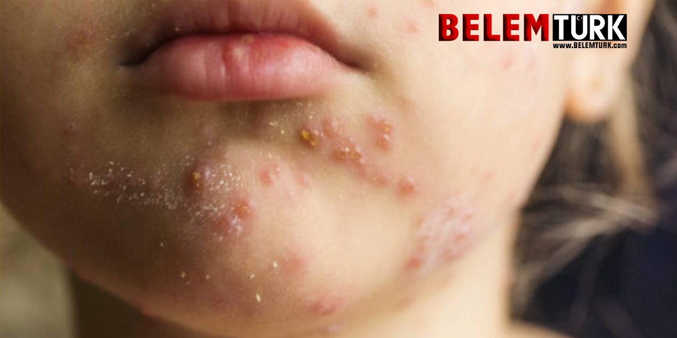 Hollanda’da kızamık alarmı