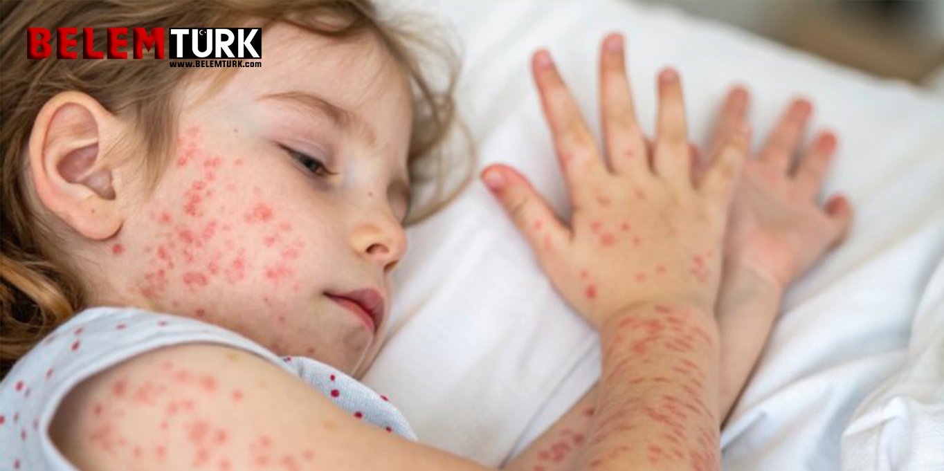 Belçika’nın Anvers şehrinde kızamık vakaları artarken Gent şehrinde durum nedir?