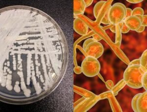 Avrupa hastanelerinde alarm : ölümcül mantar enfeksiyonu hızla yayılıyor