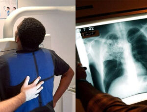 Brüksel’de göçmenler arasında tüberküloz alarmı