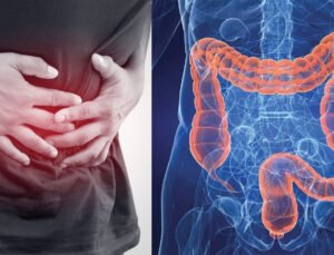 Belçika’da kolon kanseri vakaları artıyor