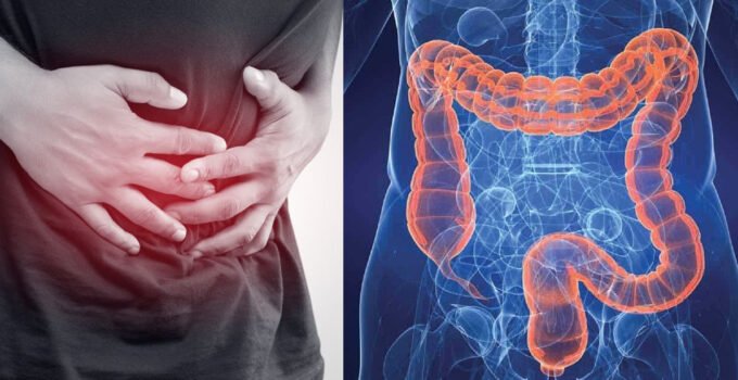 Belçika’da kolon kanseri vakaları artıyor