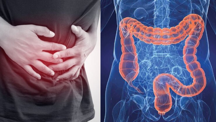 Belçika’da kolon kanseri vakaları artıyor